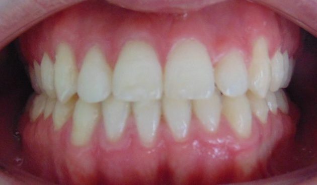 diasema cerrado con ortodoncia