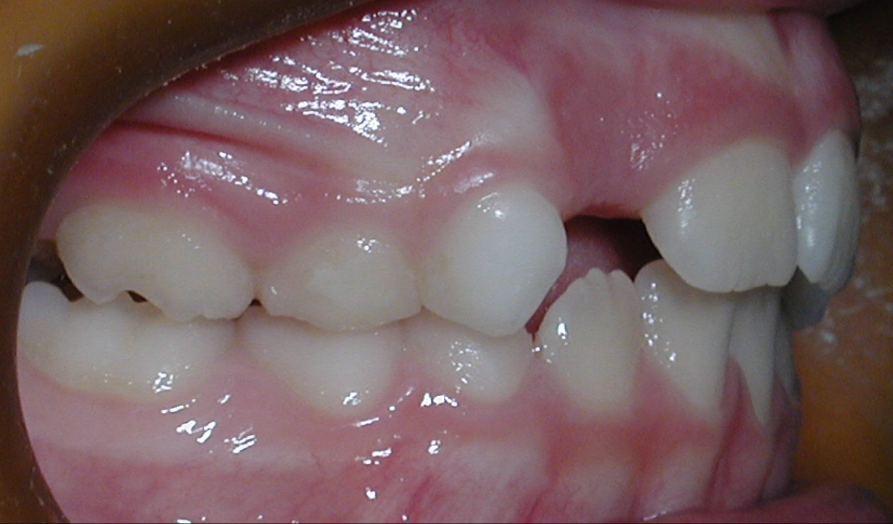 maloclusión dental
