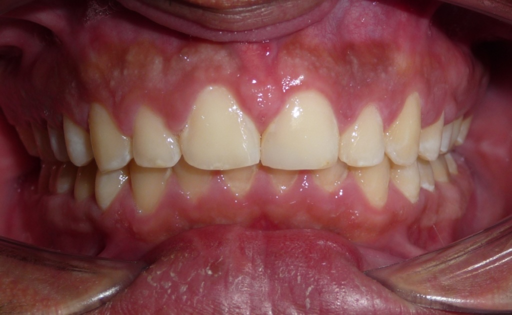 diastema cerrado tras el tratamiento de ortodoncia