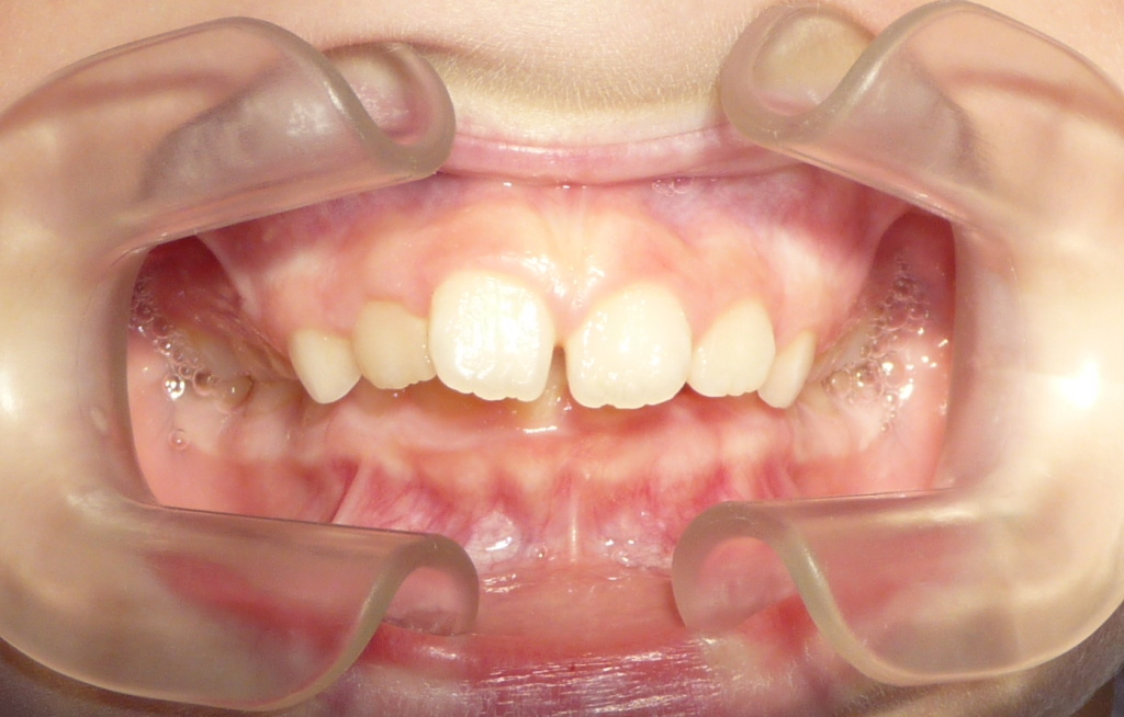 maloclusion