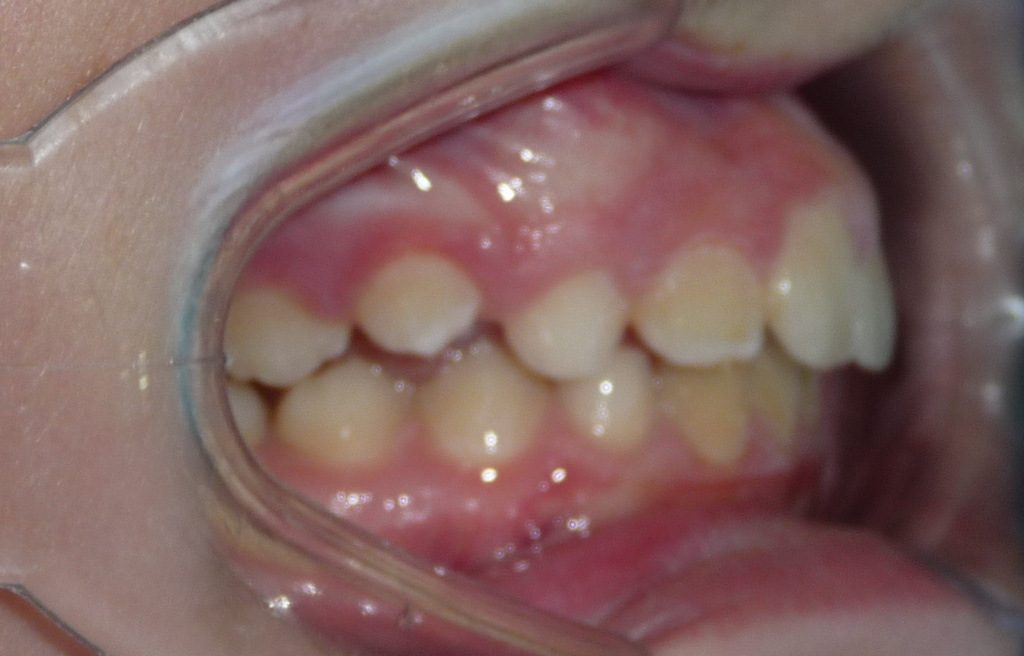 antes de la ortodoncia