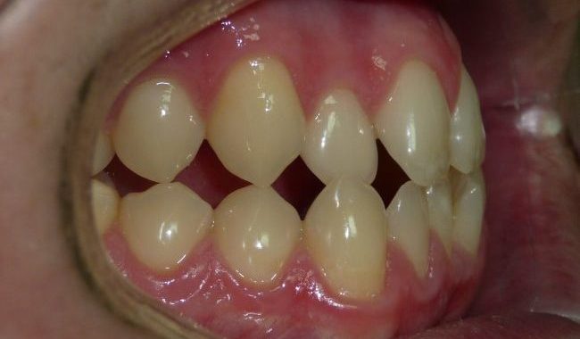 maloclusion