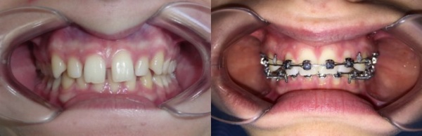 tenerife diastema ortodoncia 