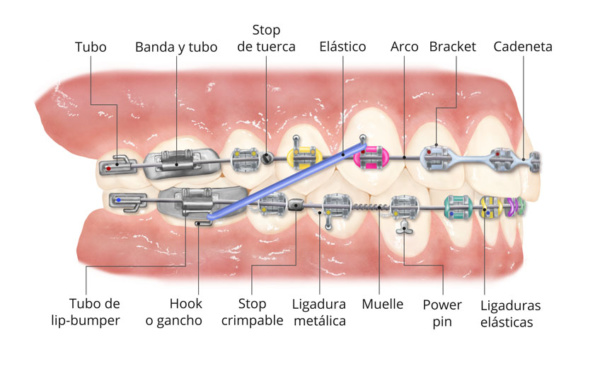 Partes de la ortodoncia con brackets - Clínica Ortodent