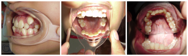 Extracciones en ortodoncia