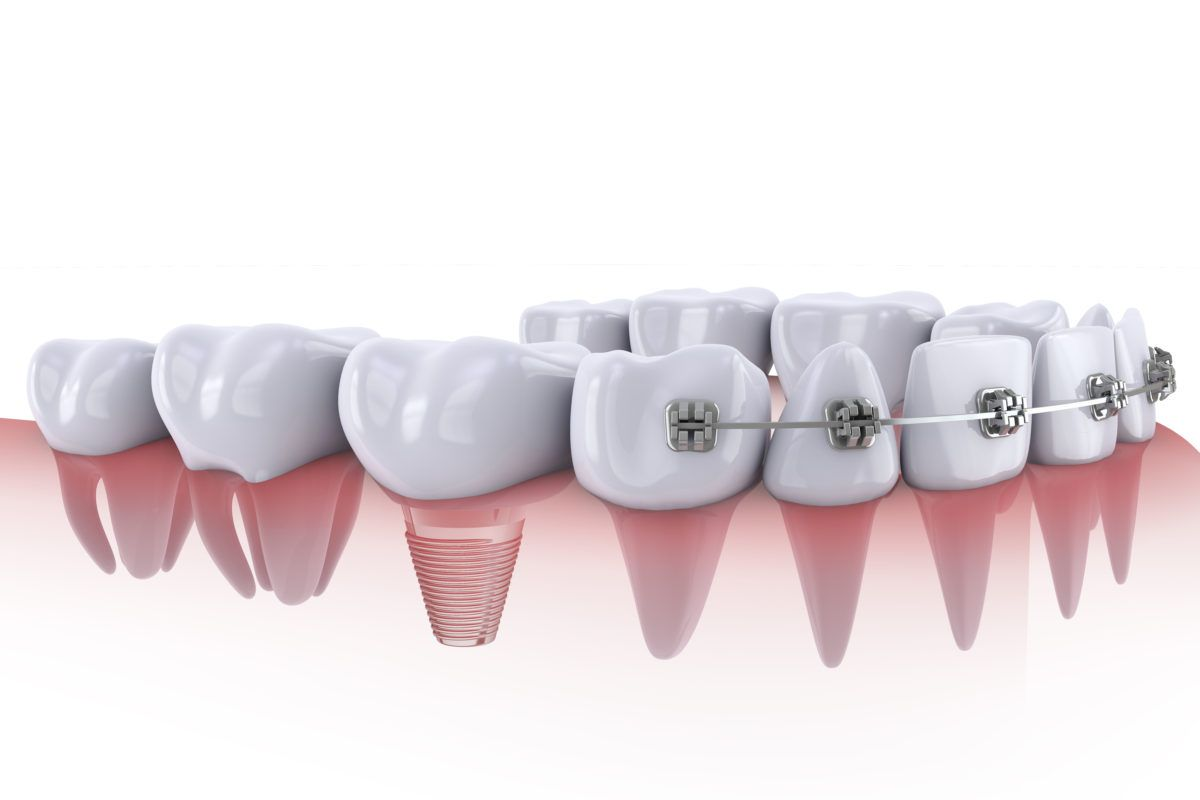 ortodoncia e implantes